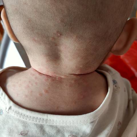 这个是什么总是反复出现天气一热就出来天气一凉就没有那么红