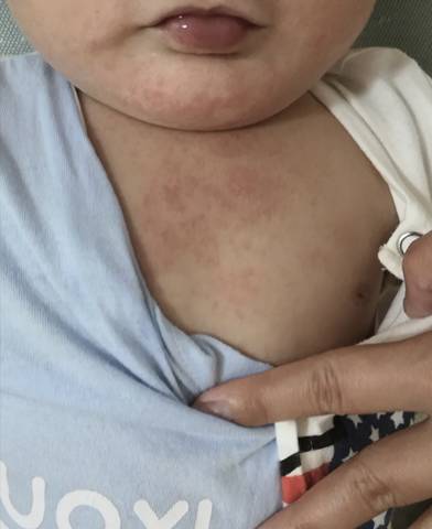 七个月宝宝起疹子图片图片