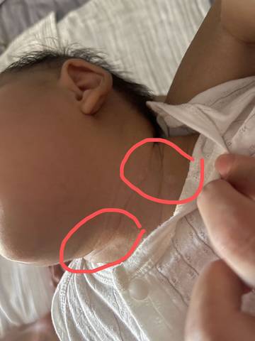 宝宝脖子上有块白好像越长越大有人知道这是什么吗?