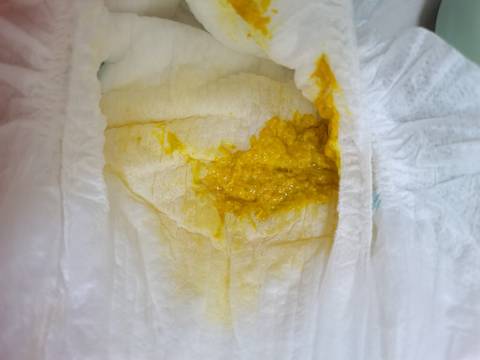 宝宝从出生开始一直拉粑粑,都是蛋花状,也吃了好几天蒙脱石散,还是