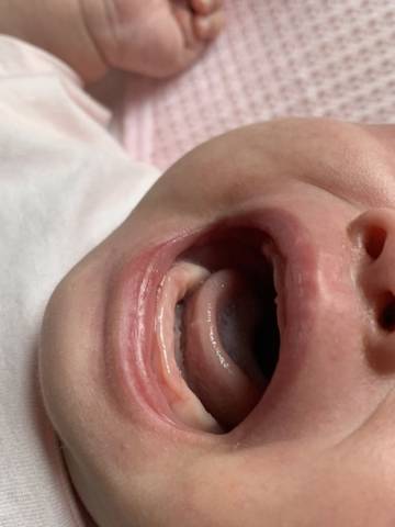 宝宝正常舌头下面筋图图片