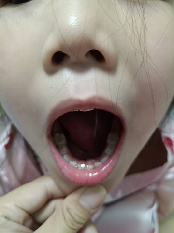 小孩牙齿横着长的图片图片