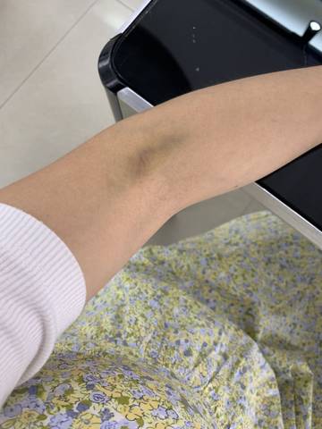 好怕抽血,每次都会胳膊疼.你们是不是抽完也这样?